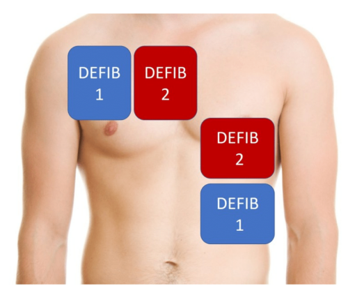 "Anterior-anterior" pad placement option for dual/double defibrillation.